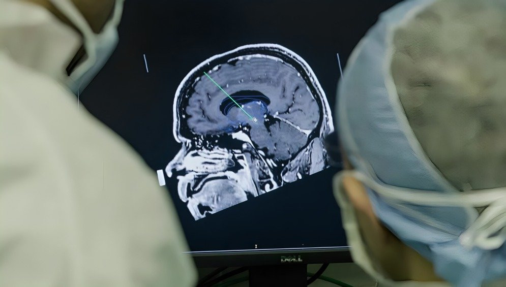 implante neural innovador el futuro de la neurociencia con nuestro. La última tecnología de grafeno en interfaces cerebrales