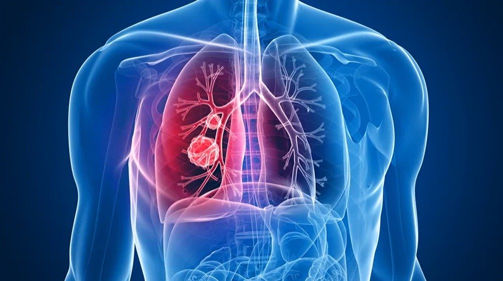 avances cáncer pulmón