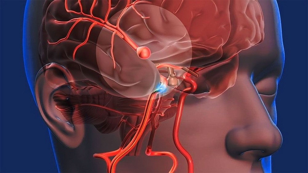 Accidente cerebrovascular