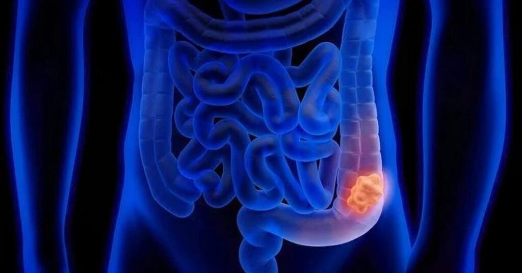 Hidroterapia de colon