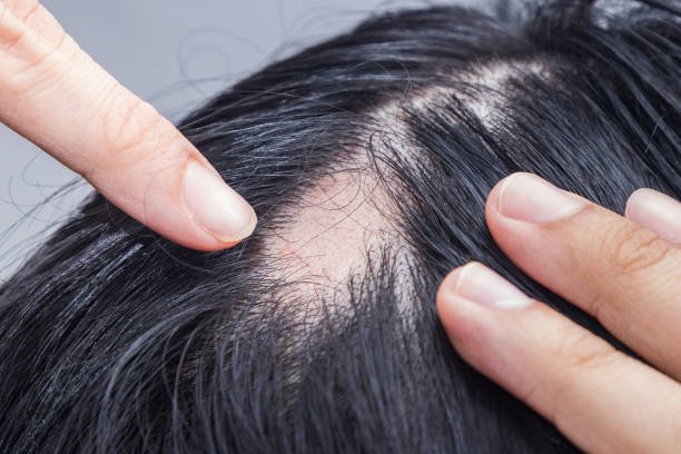 alopecia en Ecuador