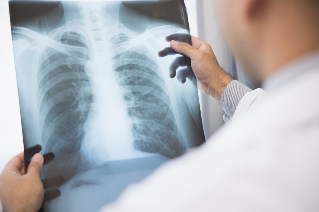 cáncer de pulmón en Ecuador