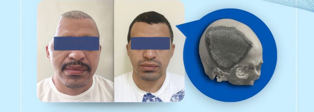 Implante de titanio personalizado fabricado por BEMART para cirugía de precisión en Ecuador