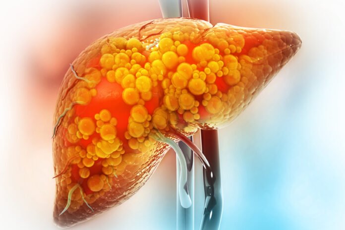 Gráfico mostrando la prevalencia de fibrosis hepática no diagnosticada en Europa, destacando la relación con factores de riesgo metabólicos y consumo de alcohol