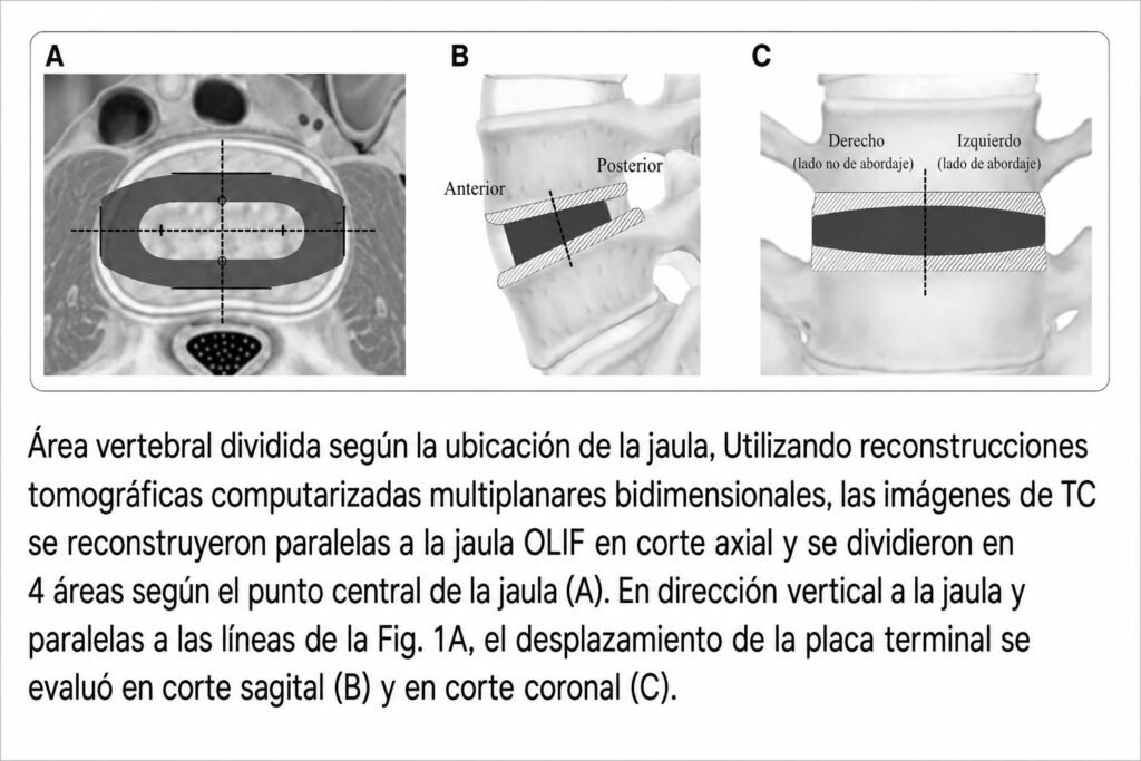 cirugía columna OLIF Ecuador