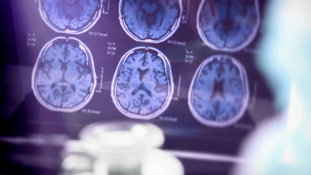 Resonancia magnética cerebral, estudio biomarcador examen de sangre anticipa el riesgo de Alzheimer en personas sanas