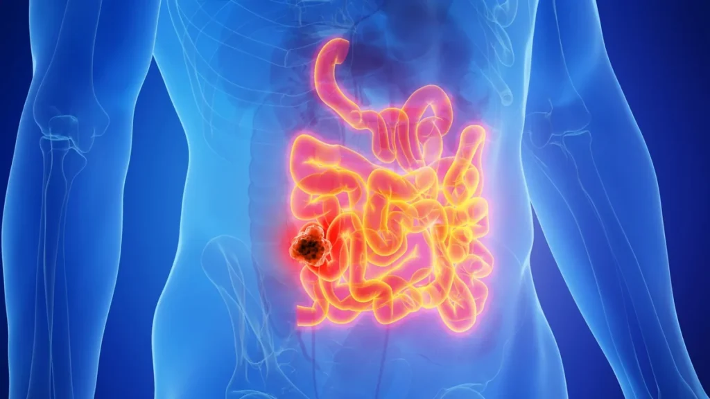 Esquema anatómico del intestino delgado y estudio sobre células tumorales