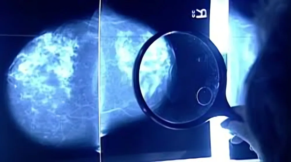 Cáncer de mama
