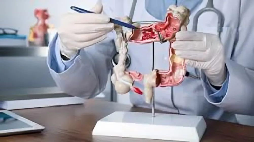 Cáncer de colon